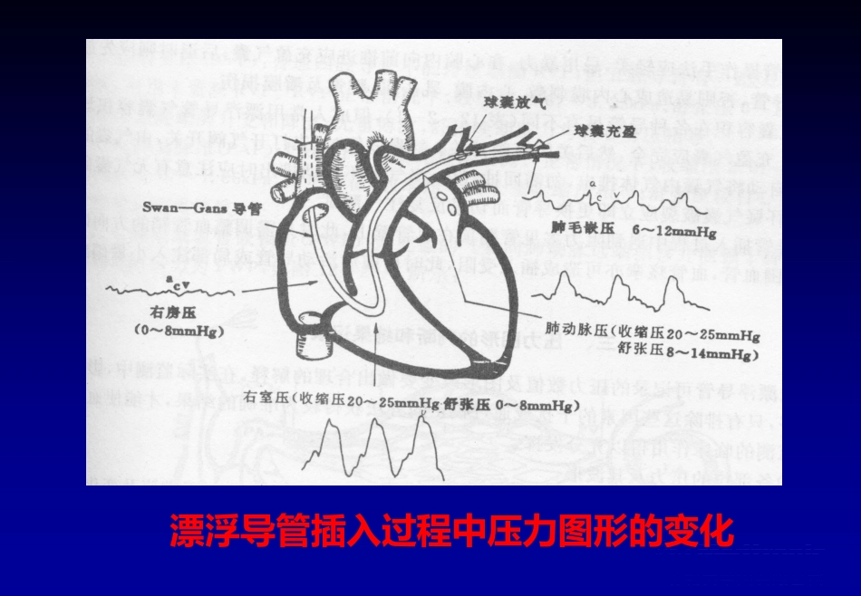 《心脏介入治疗》ppt课件_第2页