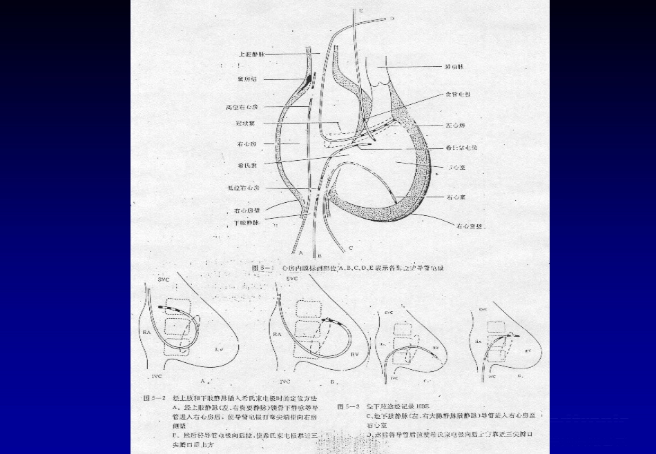 《心脏介入治疗》ppt课件_第4页