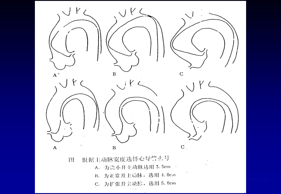 《心脏介入治疗》ppt课件_第5页