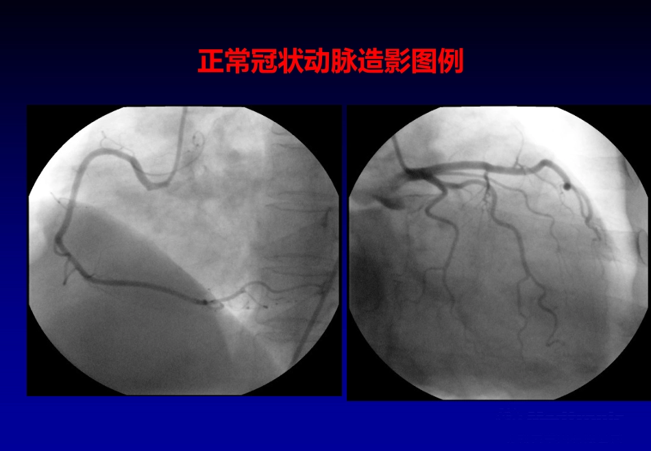 《心脏介入治疗》ppt课件_第6页