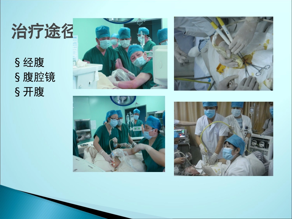 肝癌微波消融_第12页