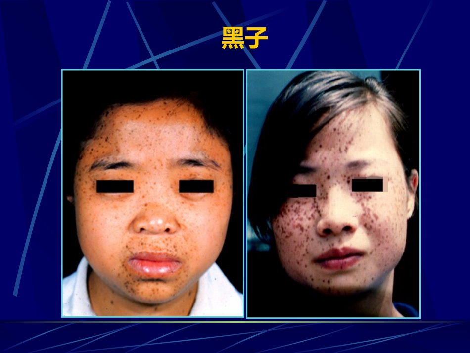 表皮色素性皮肤病_第4页