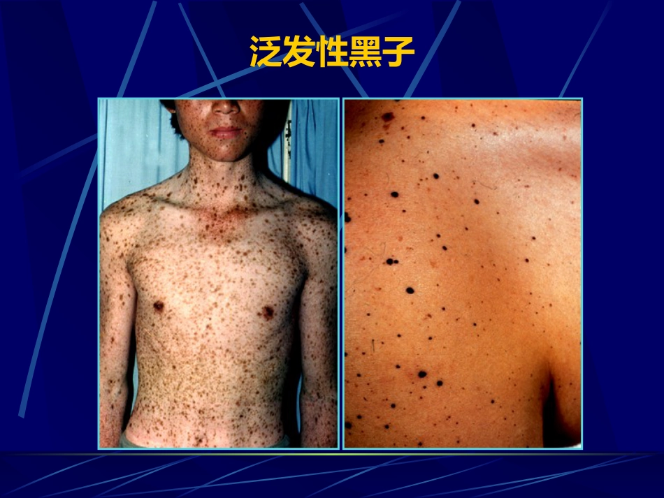 表皮色素性皮肤病_第5页