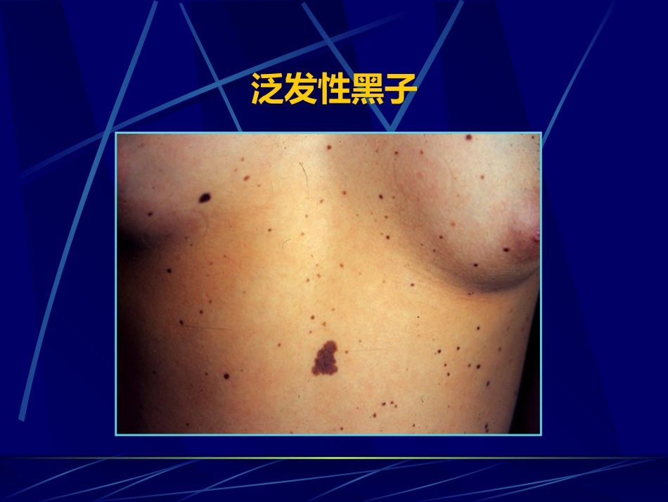 表皮色素性皮肤病_第6页
