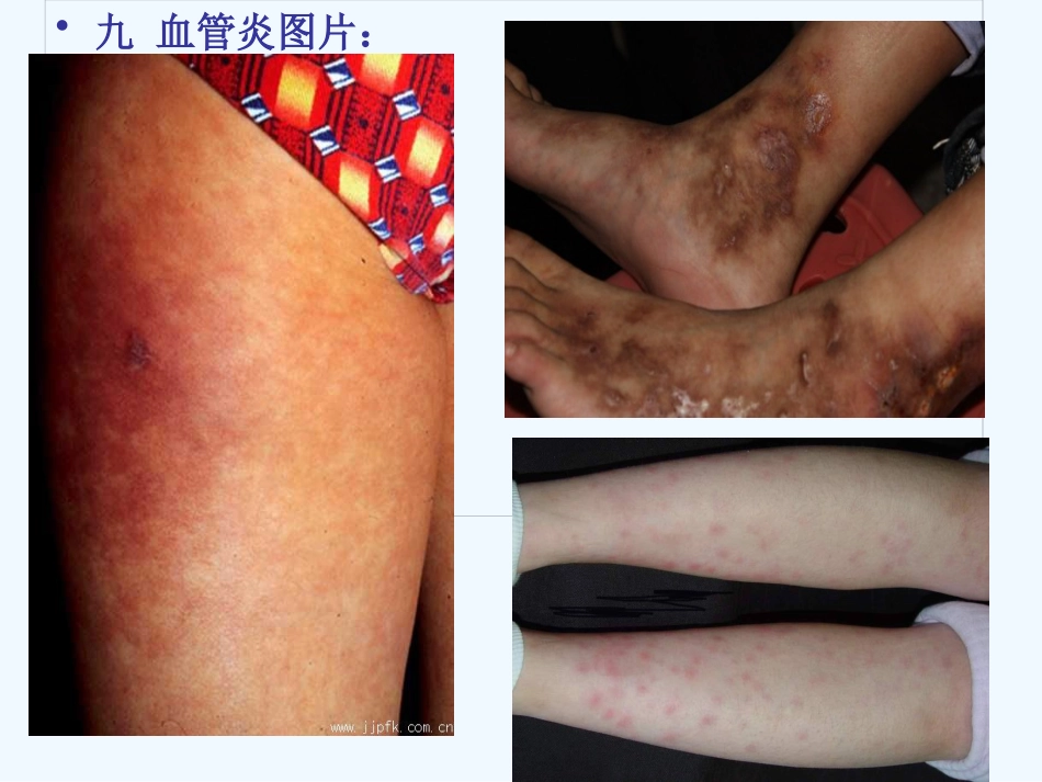 变应性血管炎 PPT_第11页