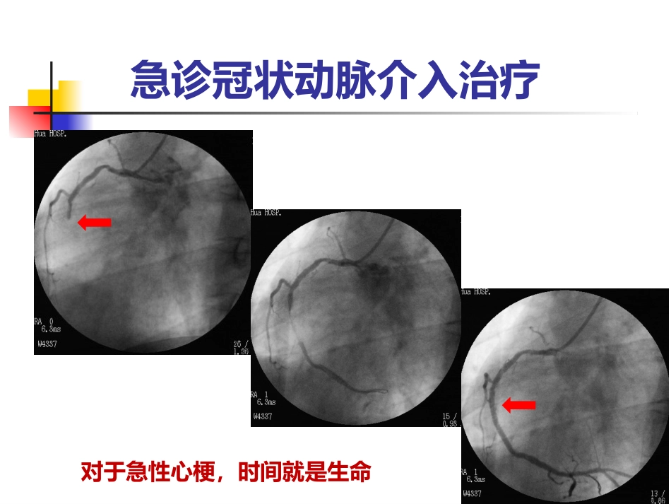 泛血管疾病介入诊疗_第10页