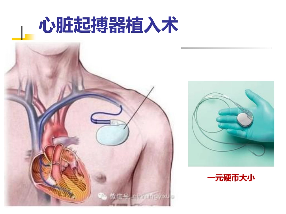 泛血管疾病介入诊疗_第14页