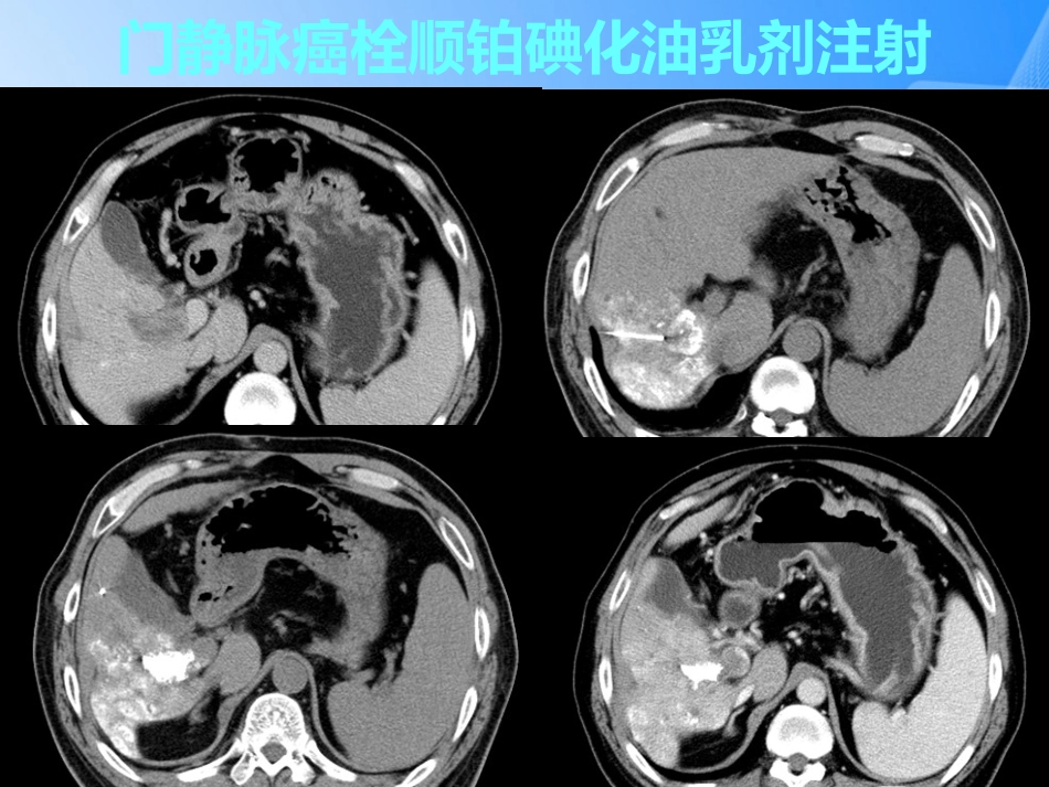 肝癌门静脉癌栓的治疗PPT_第13页