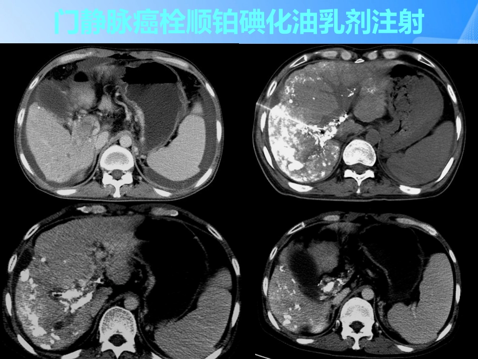 肝癌门静脉癌栓的治疗PPT_第14页