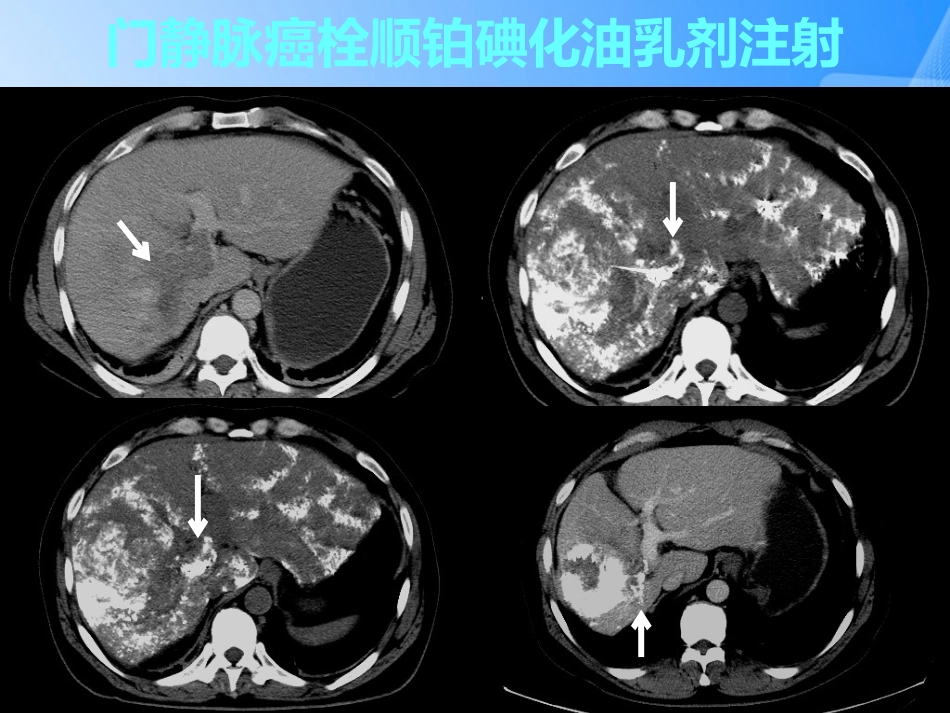 肝癌门静脉癌栓的治疗PPT_第15页