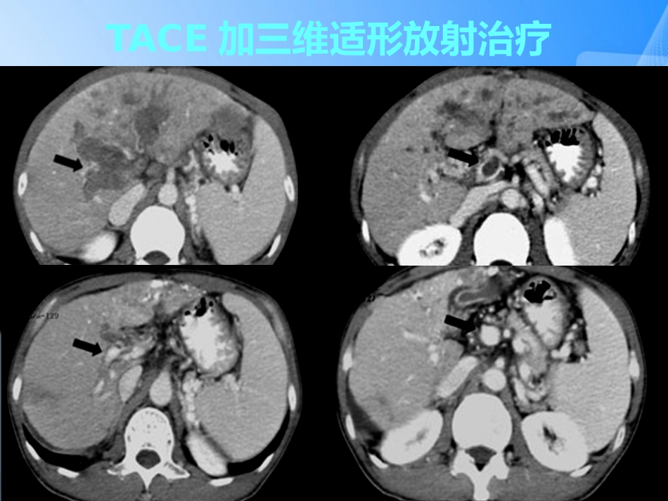 肝癌门静脉癌栓的治疗PPT_第8页