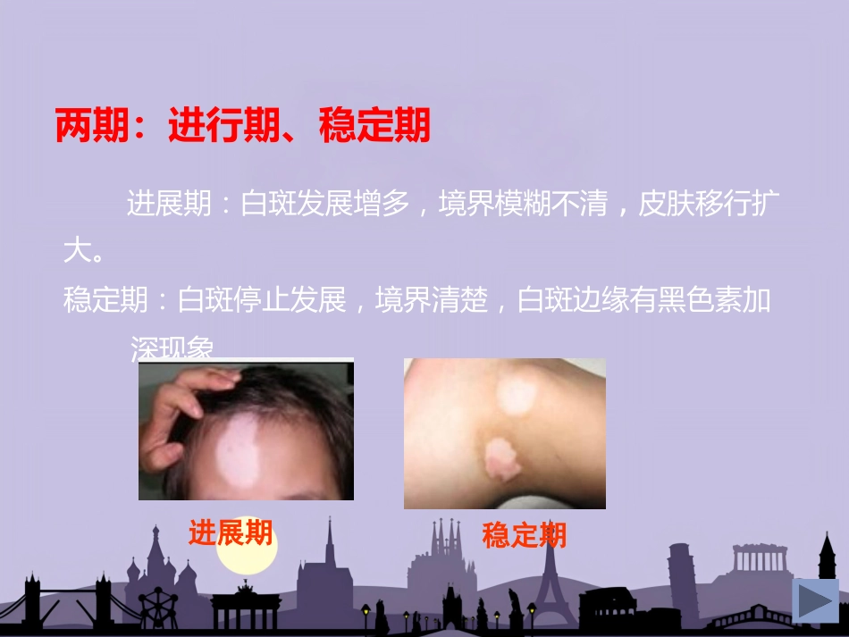 白癜风专业知识_第7页