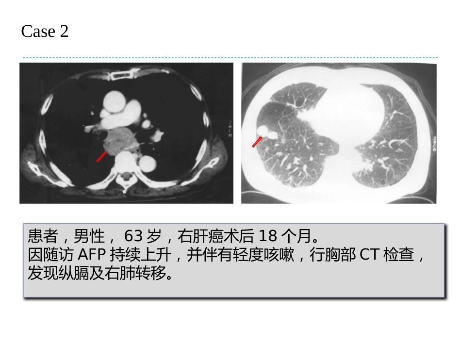 肝癌放射治疗与机体的免疫应答及临床应用前景_第7页