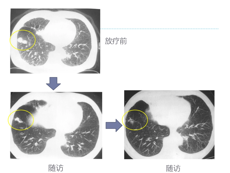 肝癌放射治疗与机体的免疫应答及临床应用前景_第9页