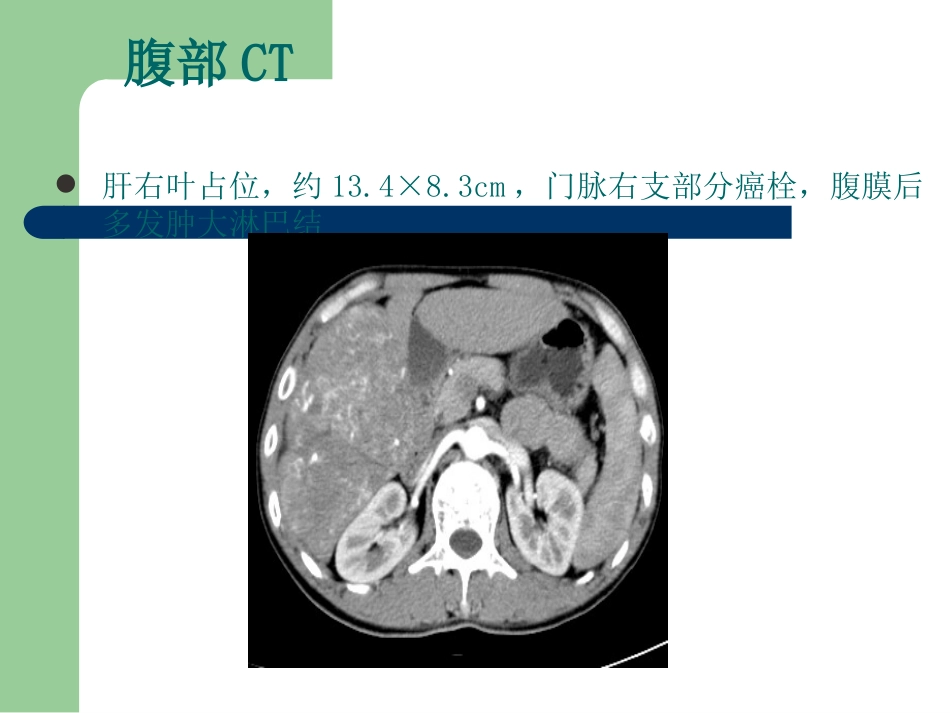 肝癌多学科协作(MDT)病例分享_第6页