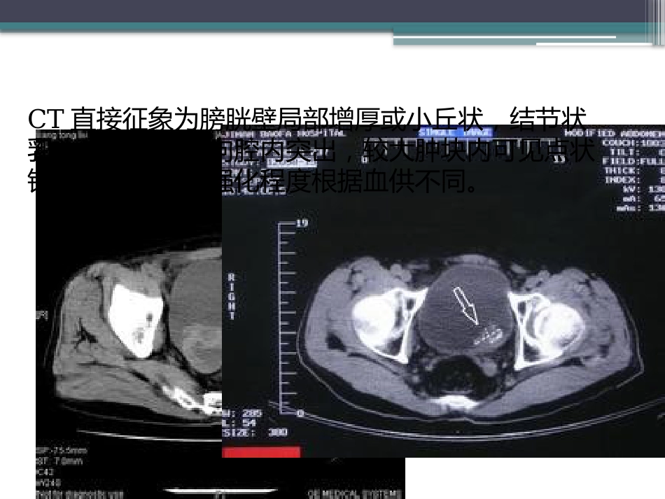 膀胱癌的介入治疗_第10页