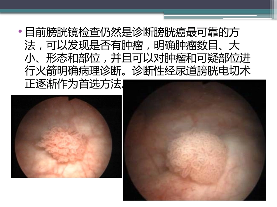 膀胱癌的介入治疗_第12页