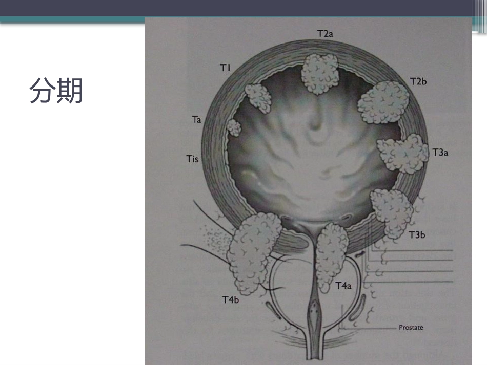 膀胱癌的介入治疗_第6页