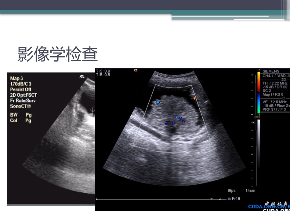 膀胱癌的介入治疗_第9页