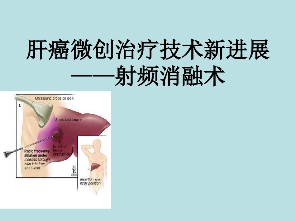 肝癌微创治疗技术新进展——射频消融术_第1页