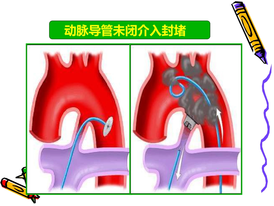 从介入医生角度论先心病合理化治疗_第3页
