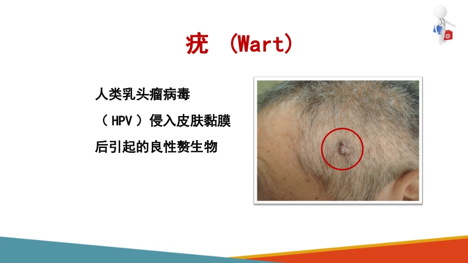 病毒性皮肤病—疣的诊疗(皮肤性病学课件)_第2页