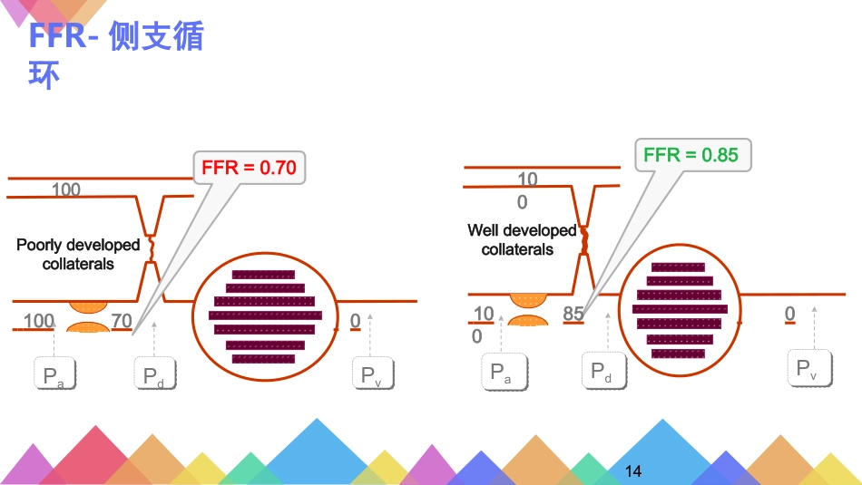 FFR优化冠心病介入治疗_第14页