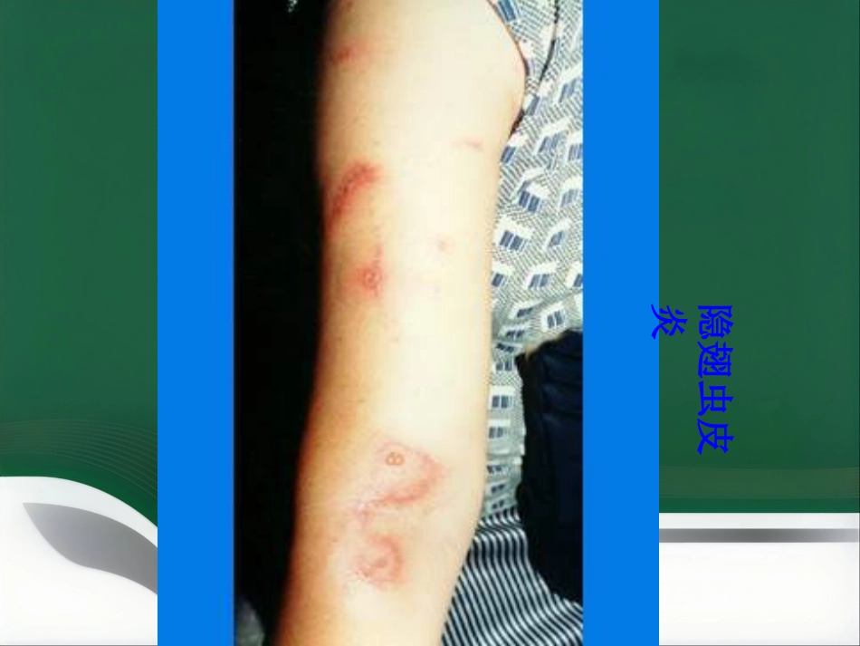 变态反应性皮肤病(1)_第10页