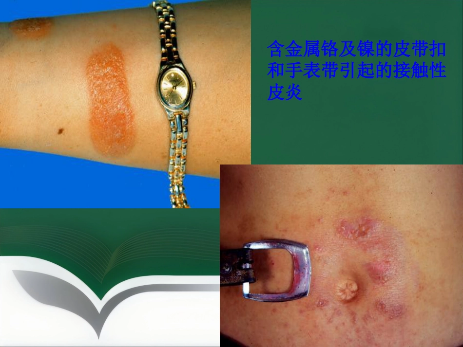 变态反应性皮肤病(1)_第11页