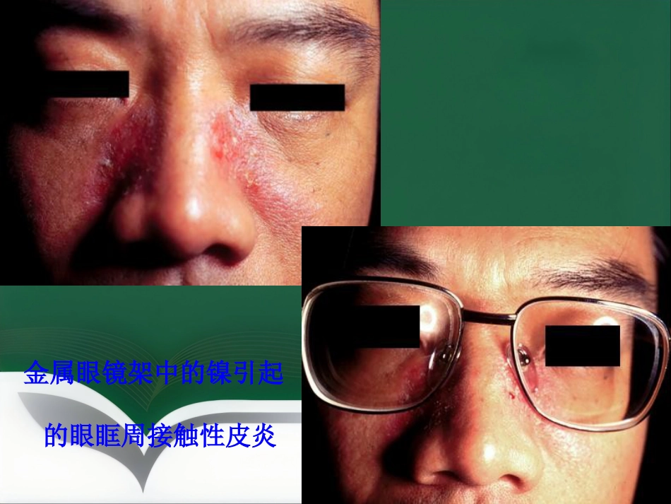 变态反应性皮肤病(1)_第13页
