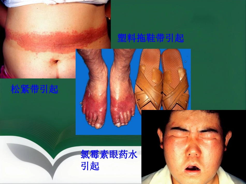 变态反应性皮肤病(1)_第14页