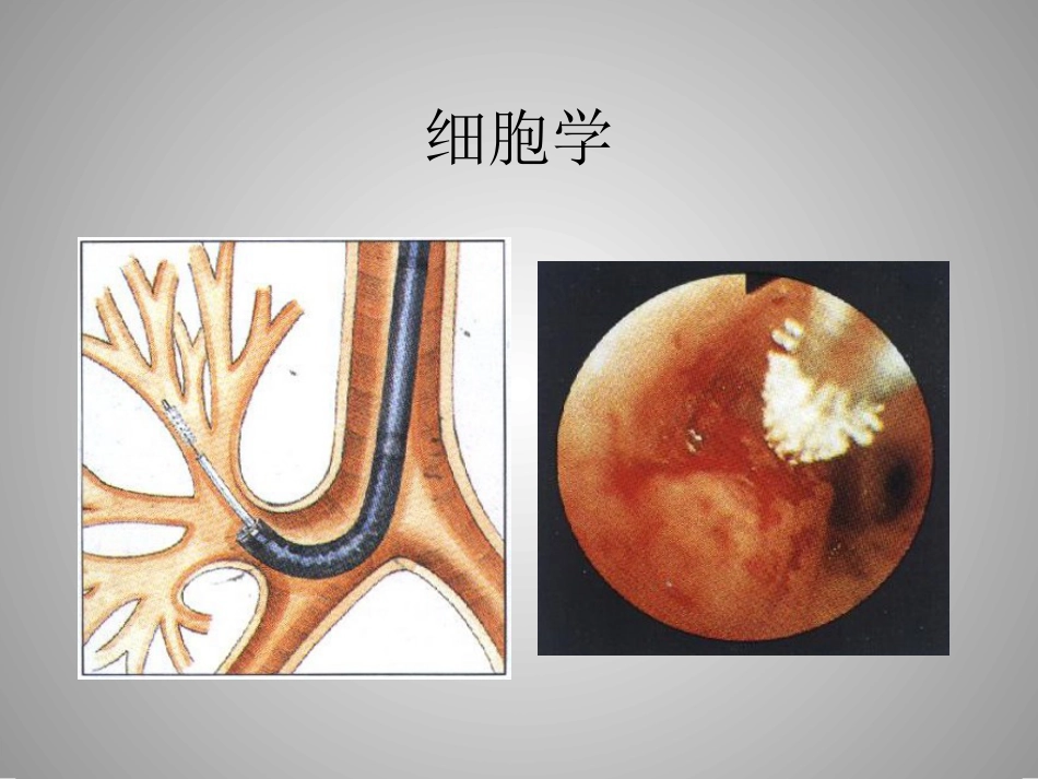 肺癌的介入诊疗技术_第10页