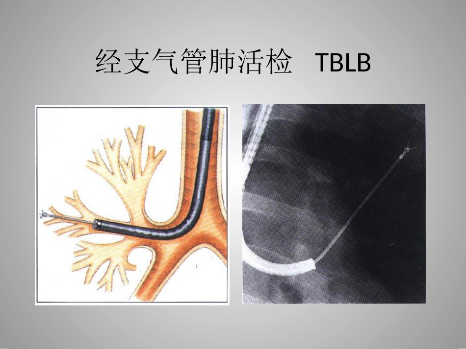 肺癌的介入诊疗技术_第11页