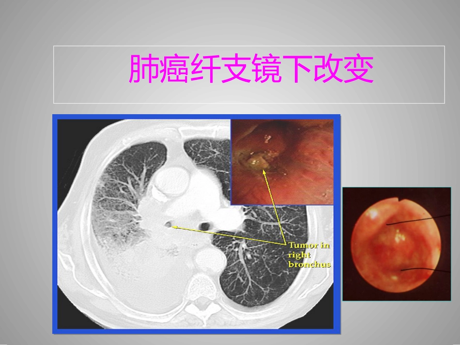 肺癌的介入诊疗技术_第12页