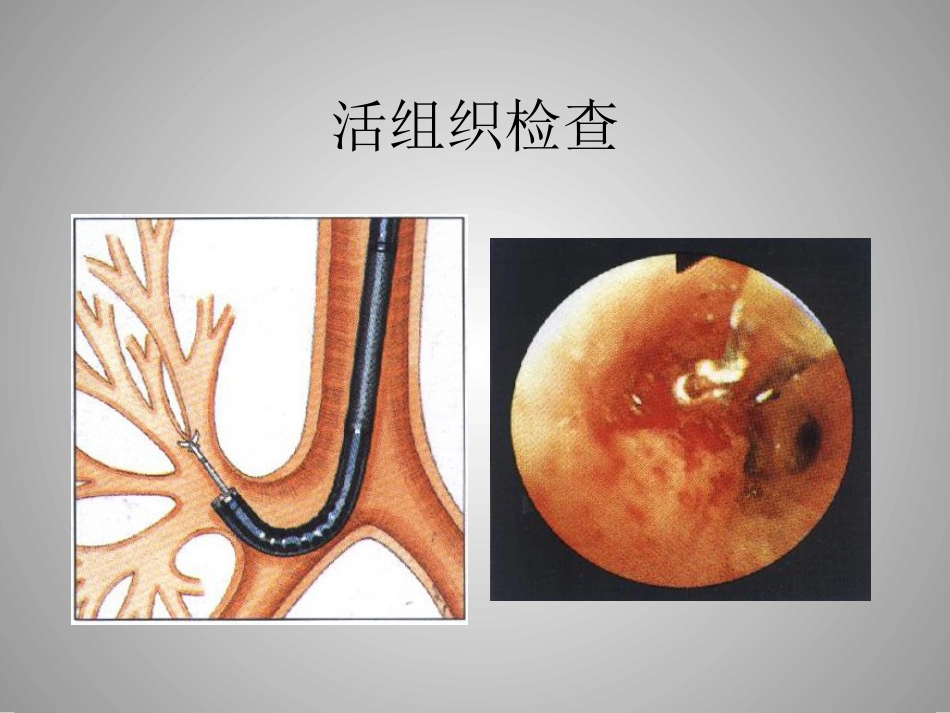 肺癌的介入诊疗技术_第9页