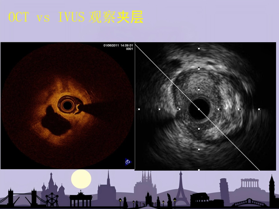 OCT在介入诊疗中的应用_第12页