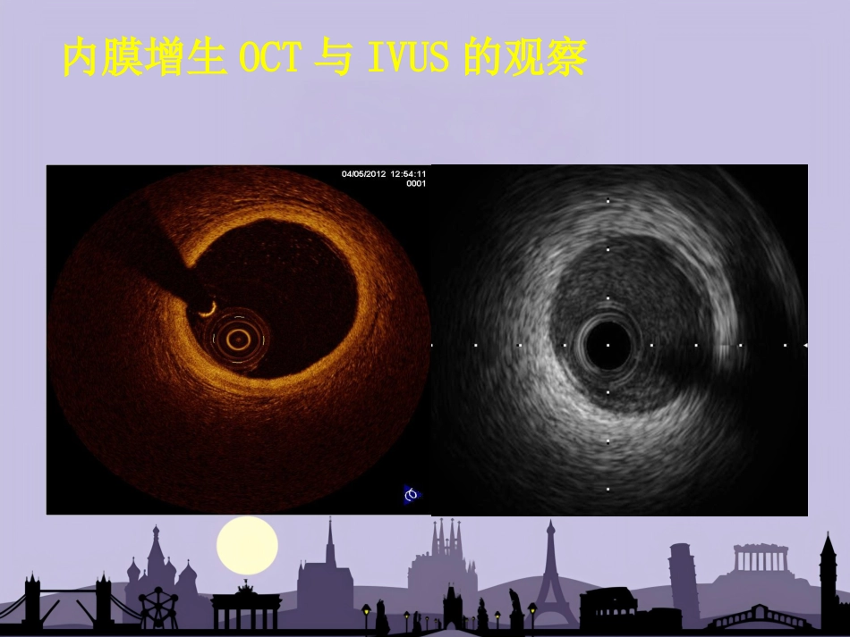 OCT在介入诊疗中的应用_第8页