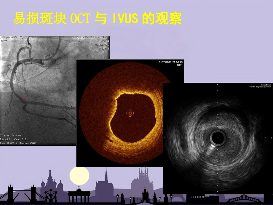 OCT在介入诊疗中的应用_第9页