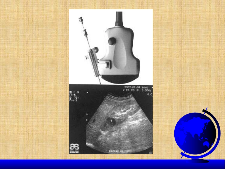 超声介入治疗_第3页