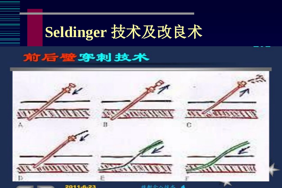 肺癌介入治疗(课堂PPT)_第11页