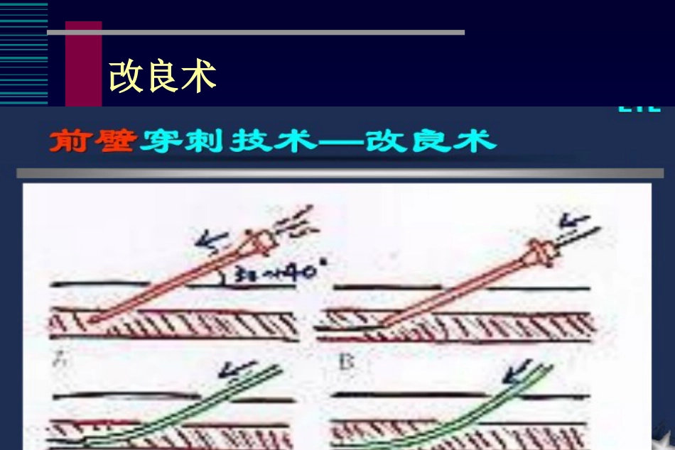 肺癌介入治疗(课堂PPT)_第12页