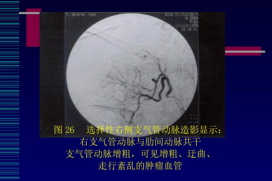 肺癌介入治疗(课堂PPT)_第13页