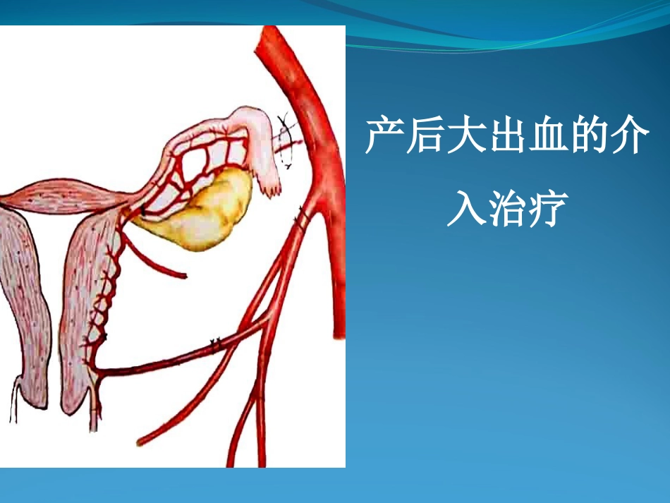 产后大出血的介入治疗_第1页