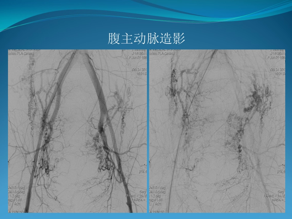 产后大出血的介入治疗_第11页