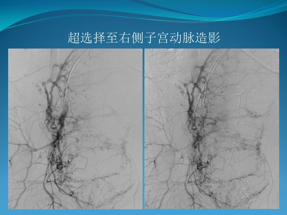 产后大出血的介入治疗_第12页