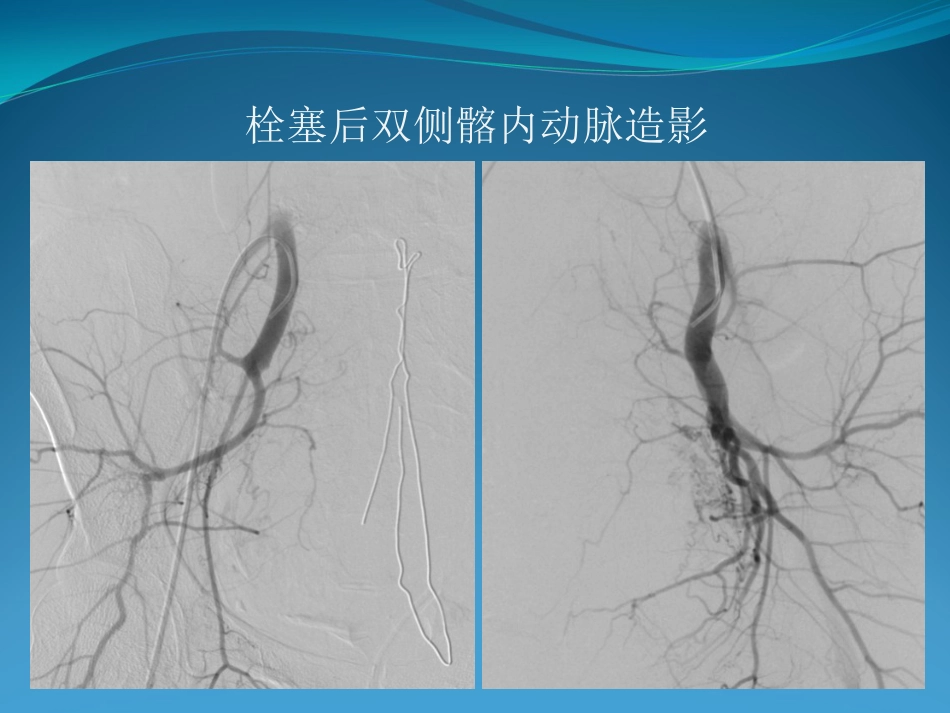 产后大出血的介入治疗_第15页