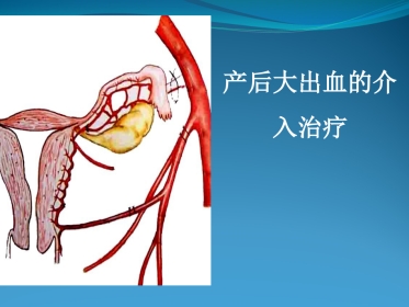 产后大出血的介入治疗