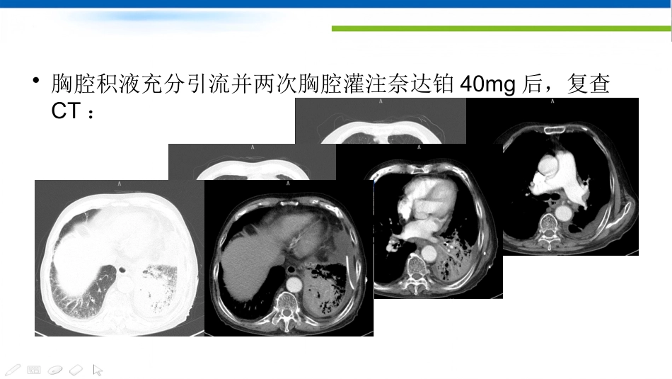 肺癌的动脉介入治疗_第14页