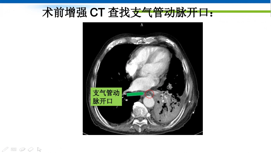 肺癌的动脉介入治疗_第15页