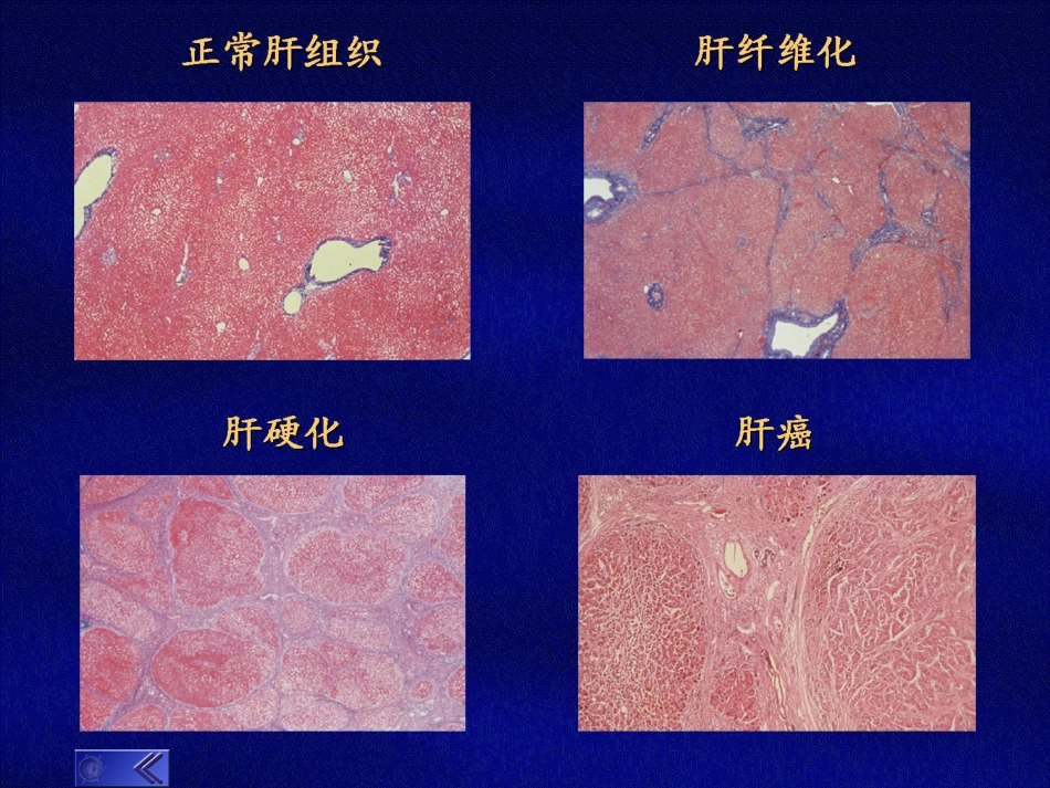 肝癌的治疗进展_第7页